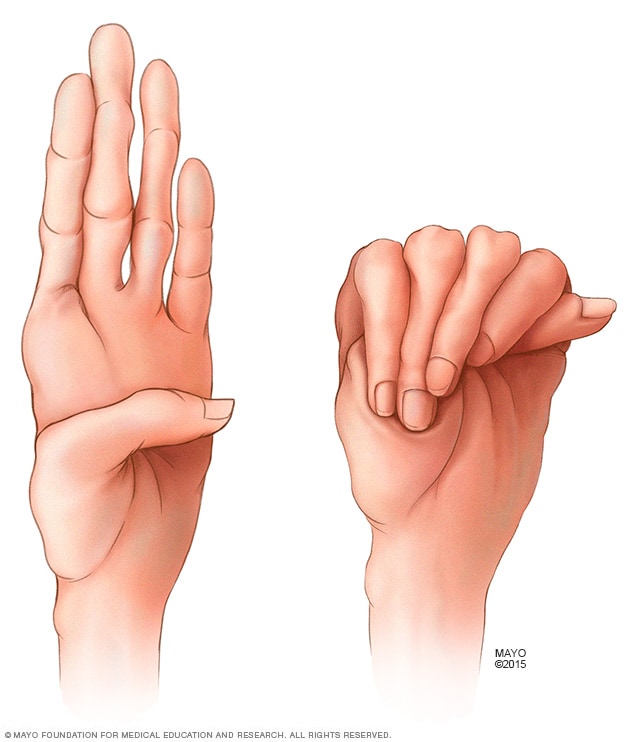 Abnormally long fingers common in Marfan syndrome
