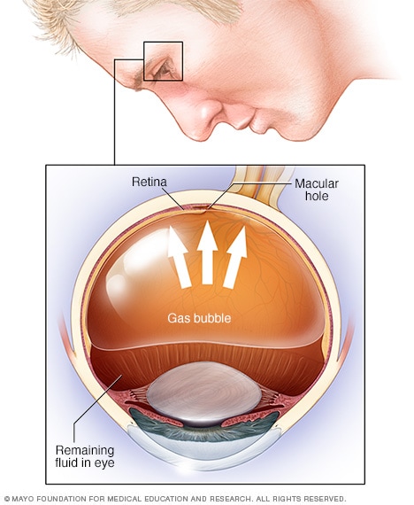 充气性视网膜固定术