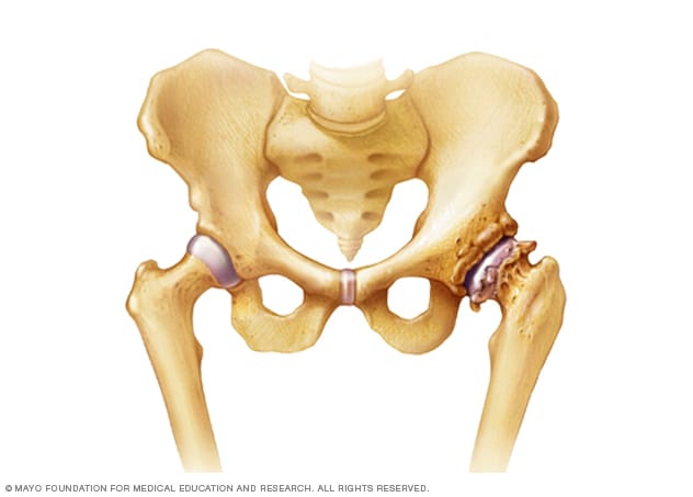 Osteoartritis en la cadera 