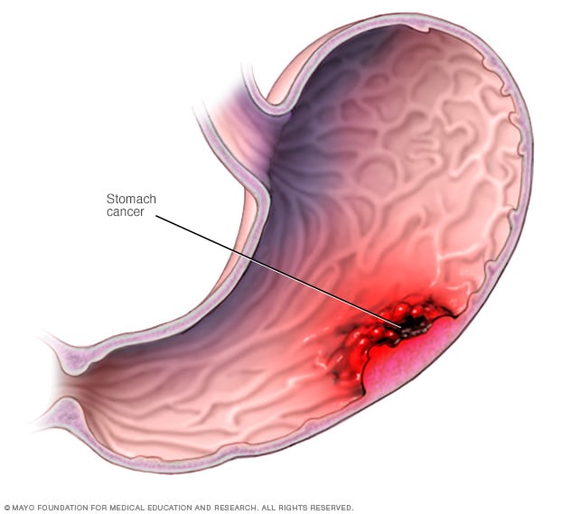 Ilustración del cáncer de estómago 
