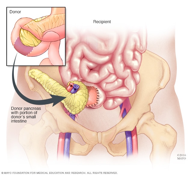 Imagen que muestra el páncreas trasplantado