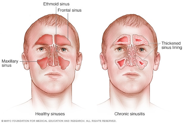 慢性鼻窦炎