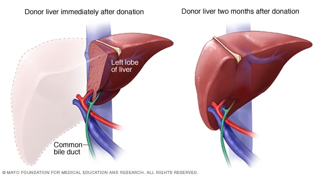 Regeneración del hígado del donante vivo