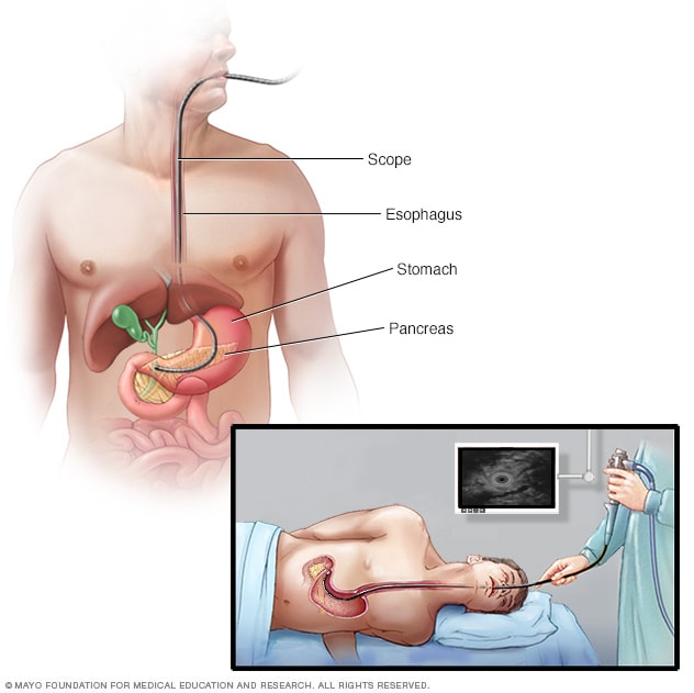 内镜下逆行胰胆管造影术 (ERCP)