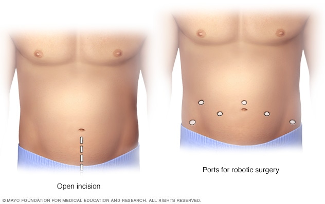 开放性前列腺切除术与机器人前列腺切除术的切口位置对比
