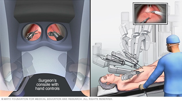 وحدة الجراح والأدوات الروبوتية المستخدمة لاستئصال المثانة