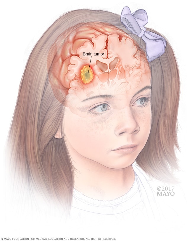 Tumor cerebral en un niño