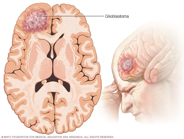 Tumor cerebral por glioblastoma