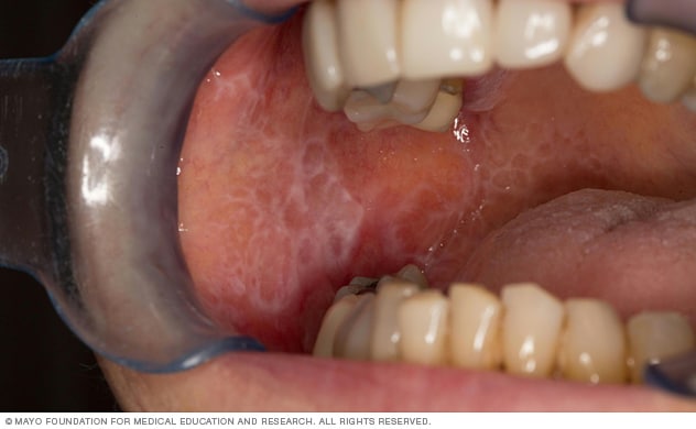 Las lesiones del liquen plano oral causan manchas blancas en forma de lazo en la boca.