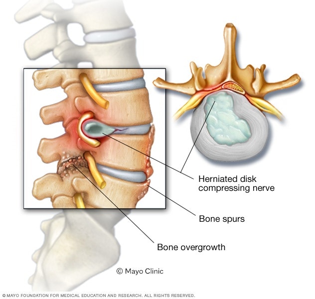 Espolones óseos y hernia de disco en la columna vertebral