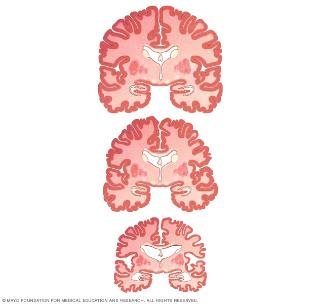 健康大脑、MCI 大脑和阿尔茨海默病大脑的尺寸差异
