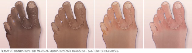 脚癣在四种不同肤色上的显示。