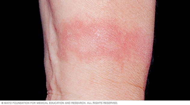 يُحتمل أن ينتج التهاب الجلد التماسي المهيِّج عن بقايا الصابون الملتصقة بالجلد.