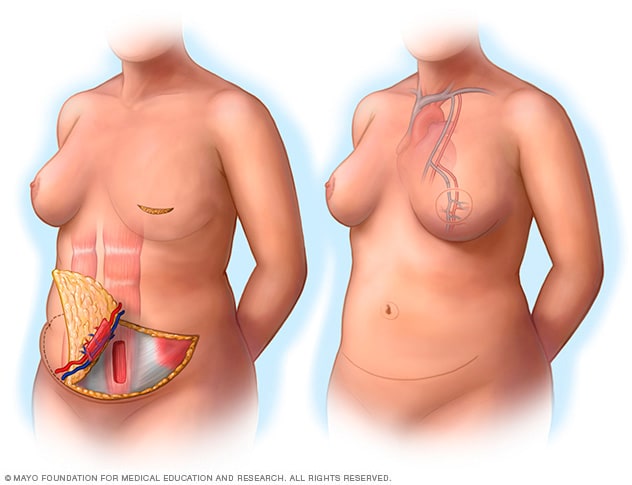 Ilustración de cirugía con colgajo miocutáneo de recto abdominal transverso libre 