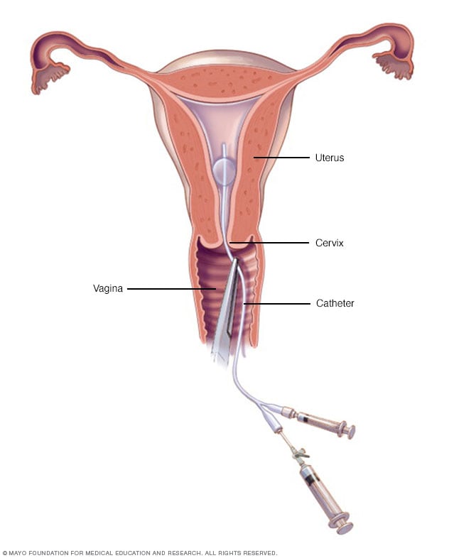 子宫输卵管造影术