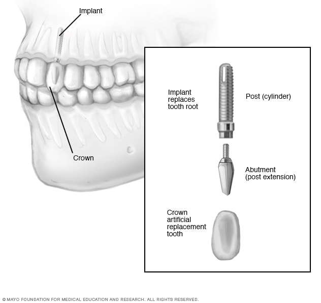 Cirugía de implante dental