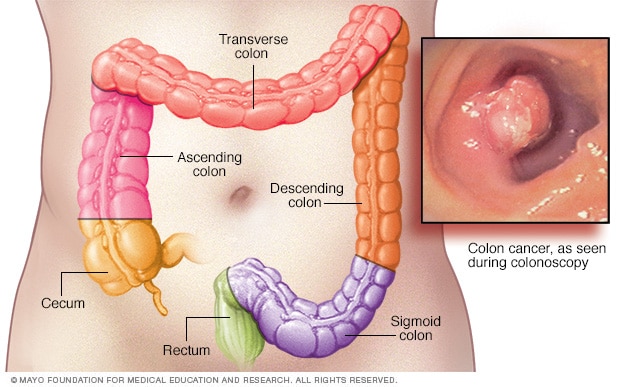 Examen para la detección de cáncer de colon 