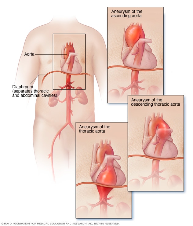 تمدد الأوعية الدموية الأبهري الصدري