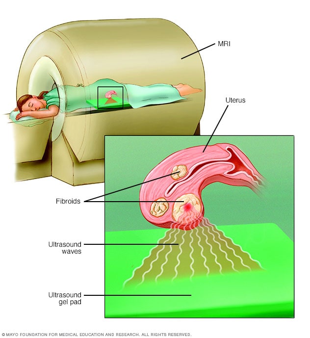جراحة بالموجات الصوتية المركزة لعلاج الأورام الليفية الرحمية