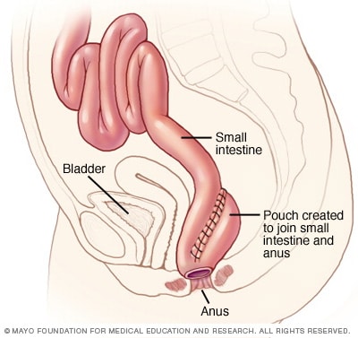 回肠肛管吻合术图示 