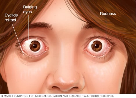 مضاعفات العين المرتبطة بداء غريفز (الدُّرَاق الجُحُوظِيّ)