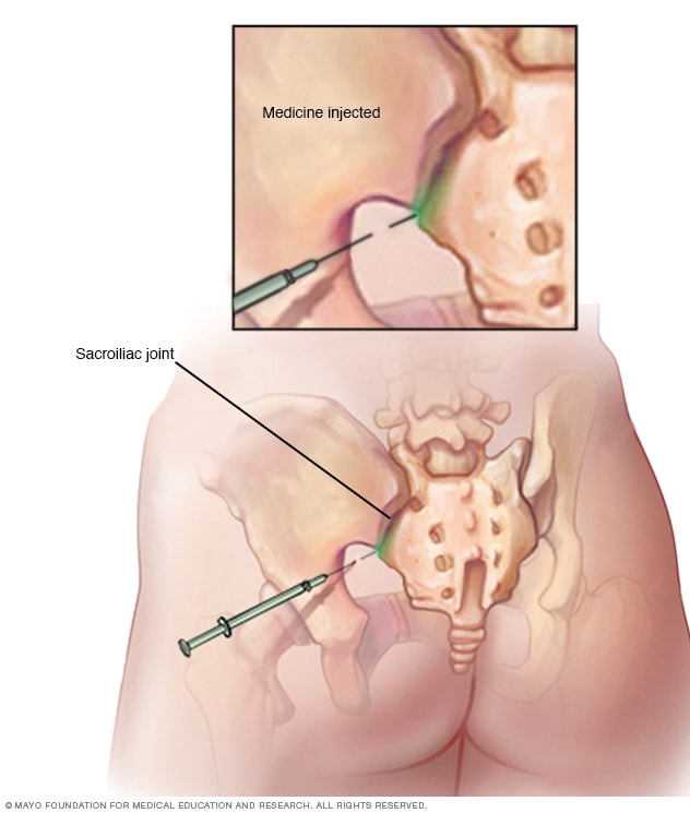 Lugar de aplicación de la inyección en articulación sacroilíaca 