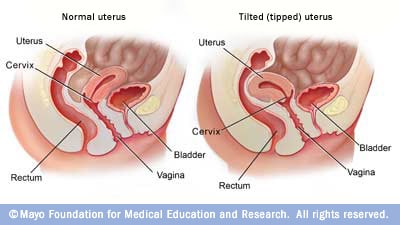 Ilustración de un útero retrodesviado
