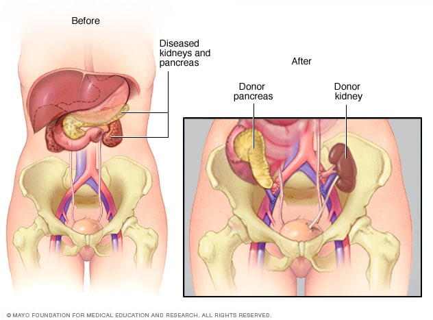 Páncreas y riñón trasplantados 