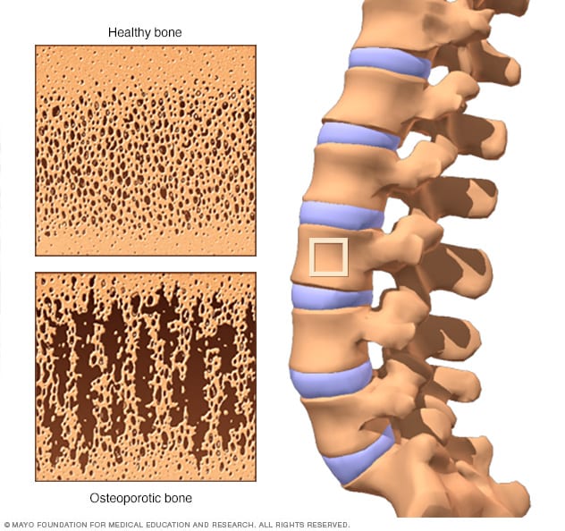 Comparación entre el interior de un hueso saludable con un hueso que se ha vuelto poroso por las osteoporosis