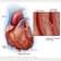 Espasmo de la arteria coronaria