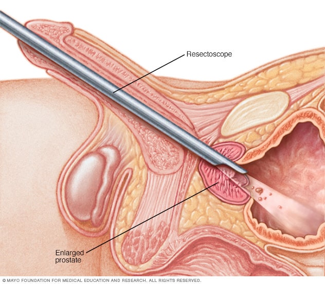 Cómo se realiza la cirugía para eliminar el exceso de tejido prostático