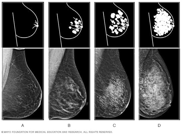 乳房 X 光检查图像，显示四种水平的乳房密度