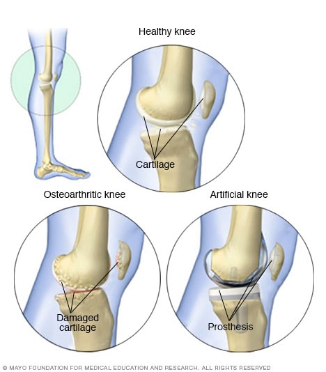 La rodilla antes y después de la cirugía de reemplazo de rodilla