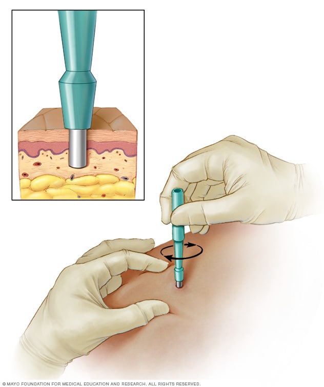 Un primer plano de un biopsia con sacabocados muestra las capas en las que se eliminó el tejido. Una imagen más grande muestra cómo la herramienta se coloca contra la piel y se inserta con un movimiento giratorio.