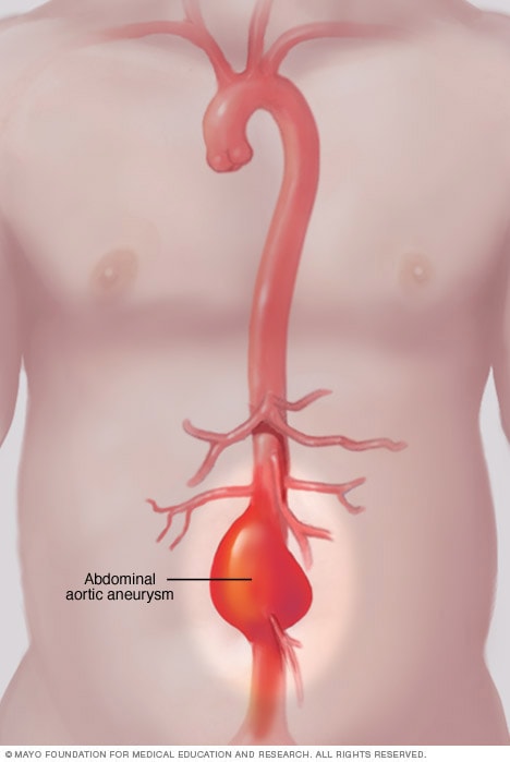 Aneurisma de aorta abdominal