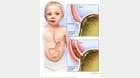 婴儿胃食管反流是怎么发生的
