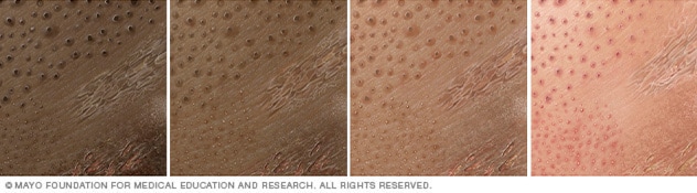 شكل التهاب الجلد التماسي على أربعة ألوان مختلفة للبشرة.