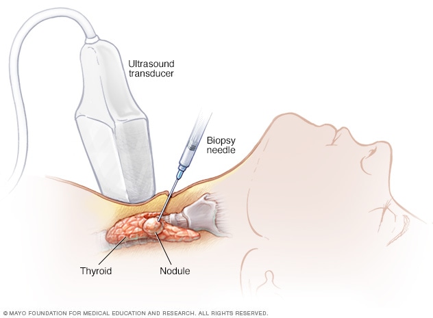 Biopsia con aguja de cáncer de tiroides 