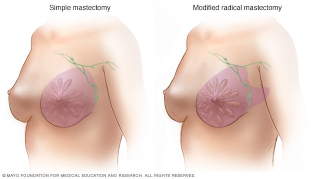 استئصال الثدي الجذري المعدل والبسيط 
