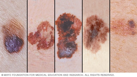 Tipos de cáncer de piel por melanoma