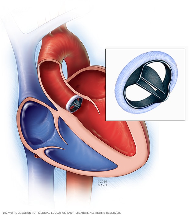 Mechanical heart valve replacement