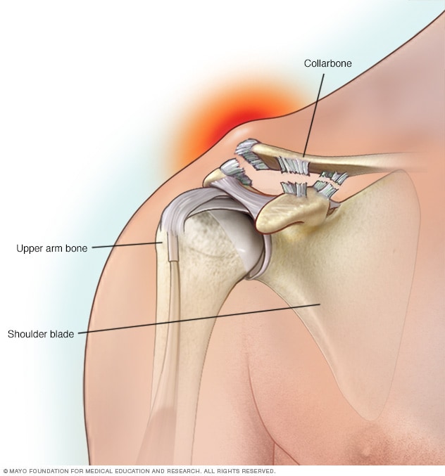 Dislocación del hombro