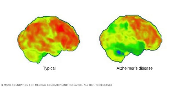 阿尔茨海默病患者大脑的正电子发射计算机断层扫描