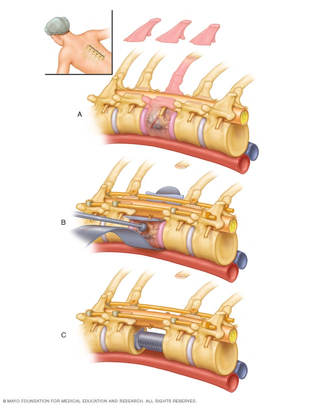 脊柱转移瘤的手术切除与稳定。