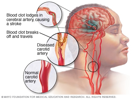Accidente cerebrovascular isquémico