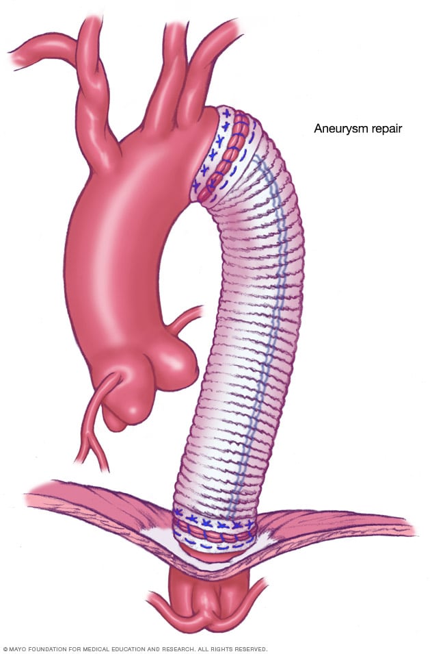 Cirugía abierta para aneurisma de aorta torácica