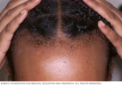 反复拉扯头发可能引起牵引性脱发。
