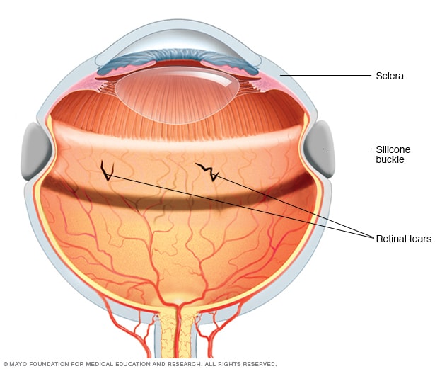 Una banda de cerclaje escleral utilizada para tratar el desprendimiento de retina