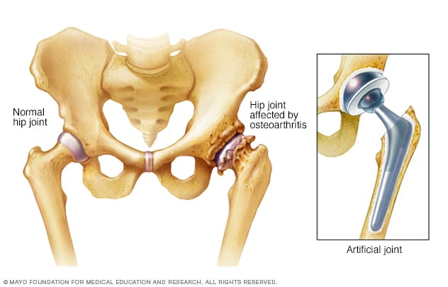 Cadera afectada por osteoartritis antes y después de un reemplazo de cadera