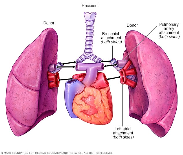 Trasplante de los dos pulmones